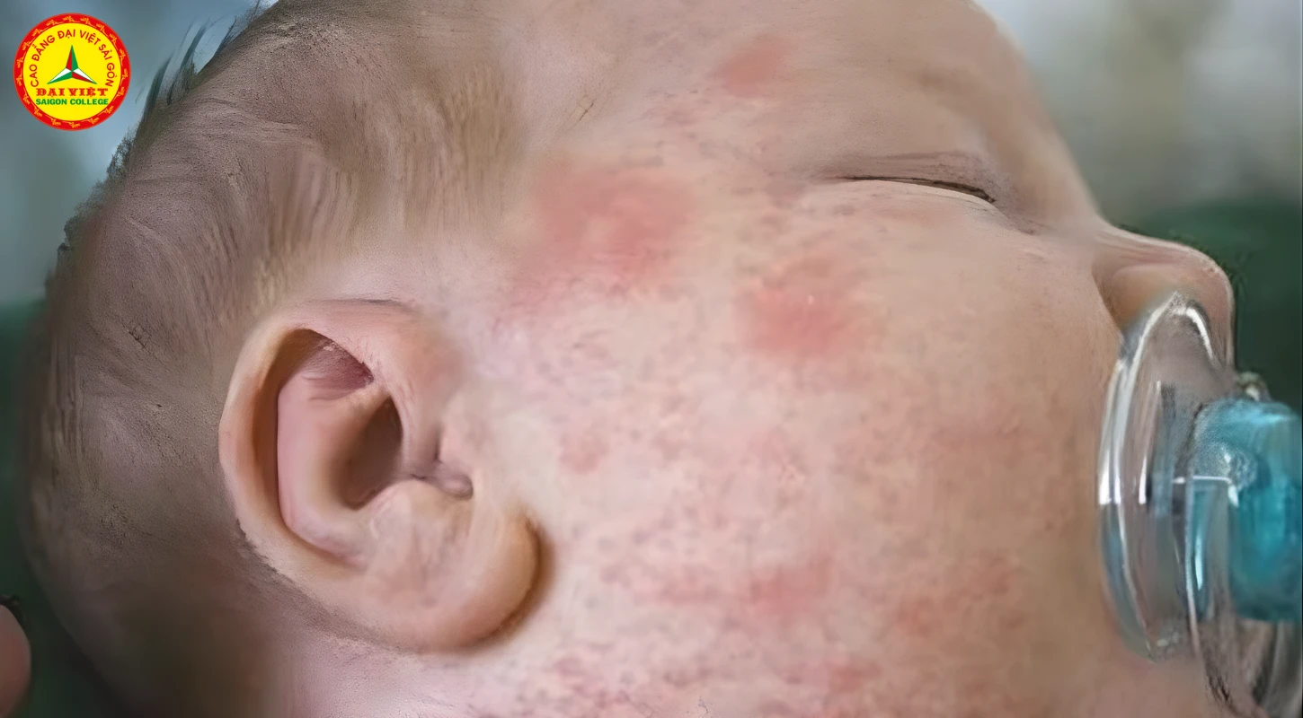 Bệnh Sởi Và Những Điều Bố Mẹ Cần Quan Tâm Trong Mùa Dịch | Trường Cao Đẳng Đại Việt Sài Gòn