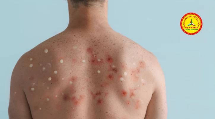 Cần Biết: 6 Biện Pháp Phòng Chống Dịch Bệnh Đậu Mùa Khỉ | Trường Cao Đẳng Đại Việt Sài Gòn