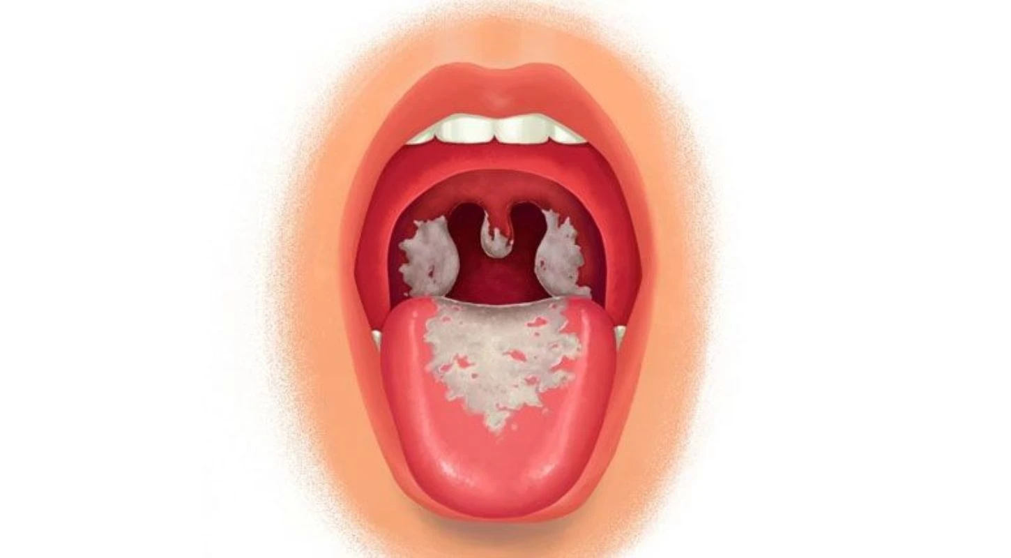 CHỦ ĐỘNG PHÒNG CHỐNG BỆNH BẠCH HẦU | Trường Cao Đẳng Đại Việt Sài Gòn