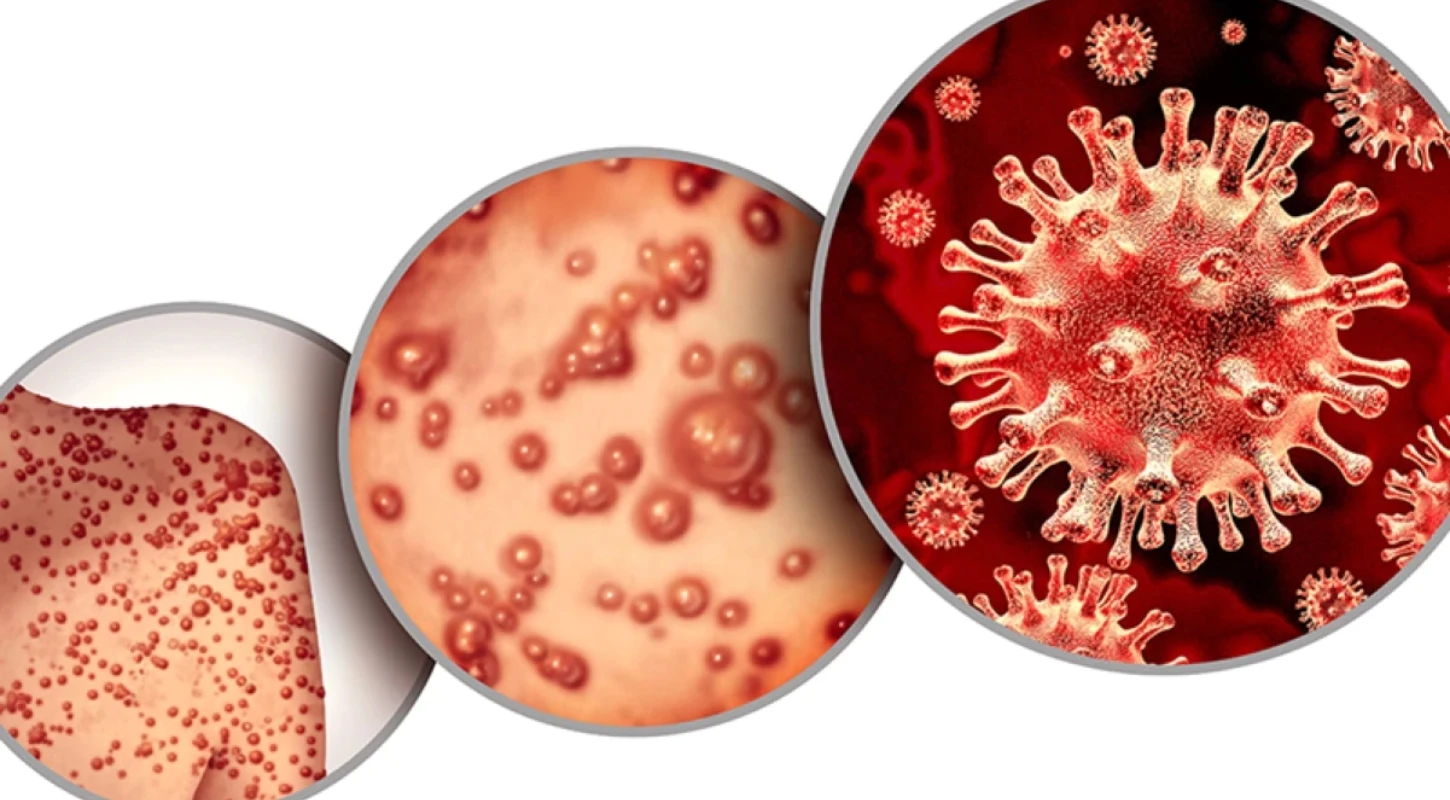 CHỦ ĐỘNG PHÒNG CHỐNG BỆNH ĐẬU MÙA KHỈ | Trường Cao Đẳng Đại Việt Sài Gòn