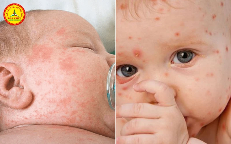 Bệnh Sởi Và Những Điều Bố Mẹ Cần Quan Tâm Trong Mùa Dịch