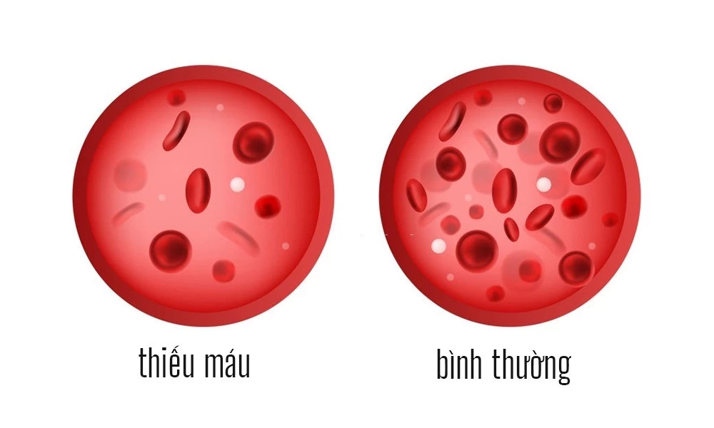 Tình trạng thiếu sắt, thiếu máu