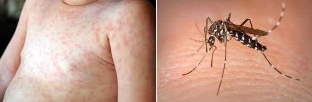 Chăm sóc tại nhà trẻ mắc bệnh sốt xuất huyết Dengue