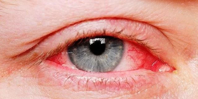Bệnh đau mắt đỏ do nhiều nguyên nhân gây ra như nhiễm trùng, dị ứng, virus, vi khuẩn...