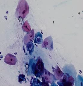 Hình ảnh tế bào Koilocytes do nhiễm HPV nguy cơ cao ở CTC