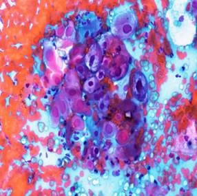 Hình ảnh tế bào Koilocytes do nhiễm HPV nguy cơ cao ở CTC