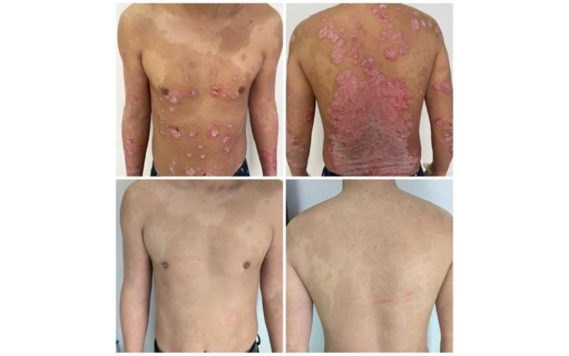 Thuốc Sinh Học - Bước Tiến Mới Trong Điều Trị Vảy Nến